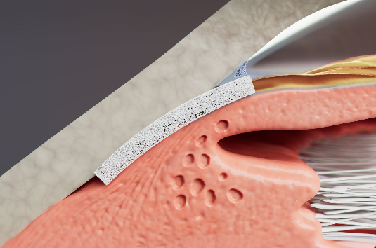 AlloFlo Uveo scleral allograft reinforcing the endoscleral wall