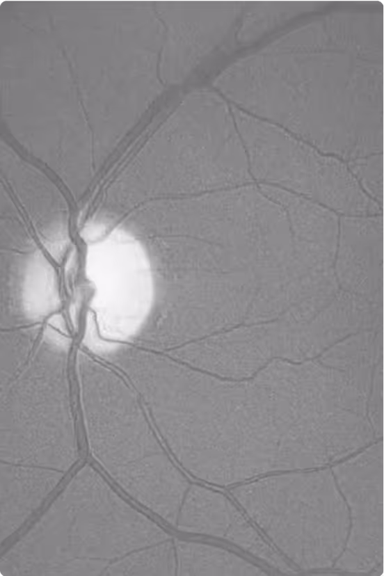 Propionic Aciduria Optic Neuropathy